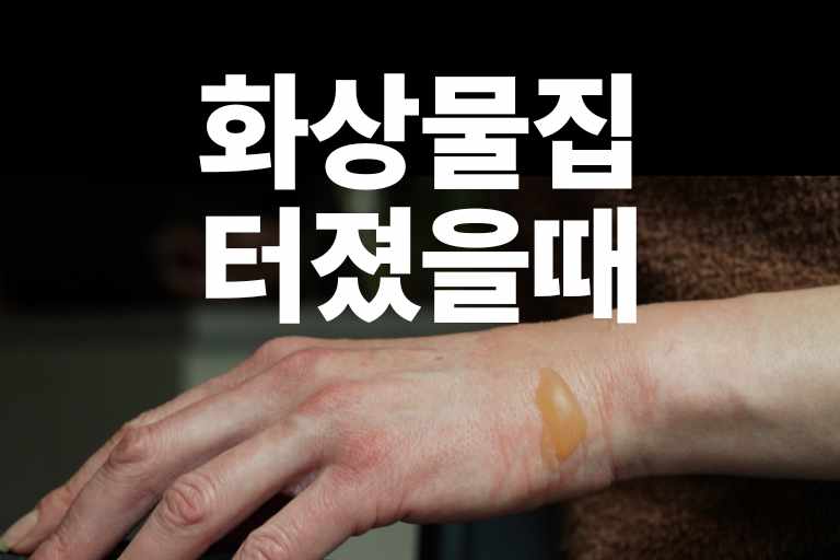 화상물집 터졌을때